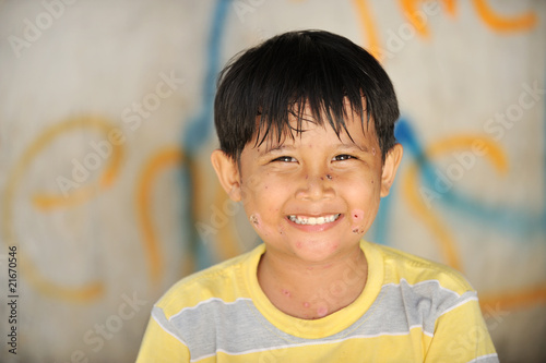 Photo: Chickenpox Chickenpox