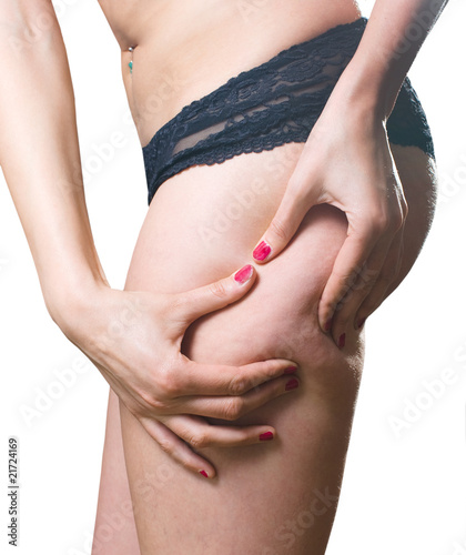 Photo: Cellulite Cellulite