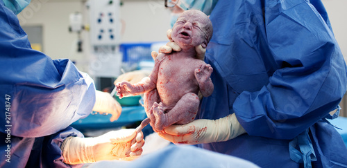 Photo: Baby being born via Caesarean Section Baby being born via Caesarean Section