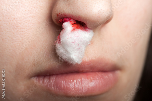 Nosebleed