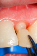Temporary crown for tooth