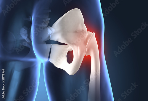 Illustration: Painful human hip Painful human hip