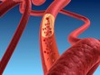 Ader mit  Arteriosklerose