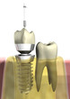 Zahnersatz_Implantat