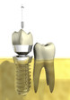 imPLANtat