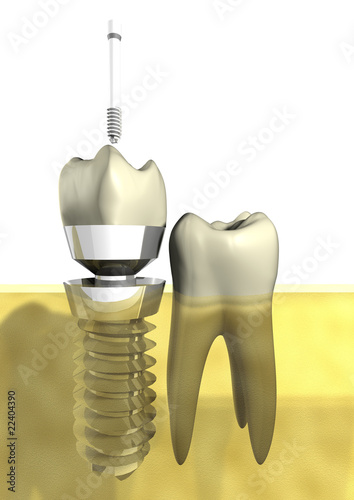 Illustration: imPLANtat imPLANtat
