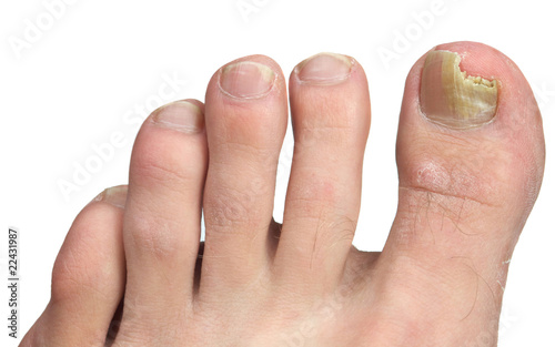 Photo: Toenail Fngus at Peak Infection Toenail Fngus at Peak Infection