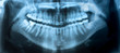 Dental X-Ray panoramic
