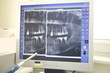 Xrays of dental work on teeth