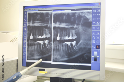 Photo: Xrays of dental work on teeth Xrays of dental work on teeth