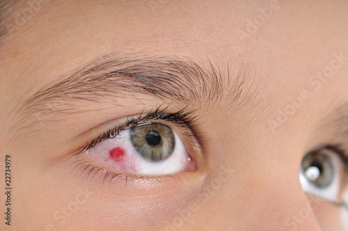 Photo: High resolution macro photo of an infected child eye High resolution macro photo of an infected child eye