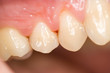 teeth, gingivitis
