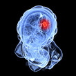 weiblicher Schädel mit Hirntumor