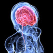 Illustration - Hirntumor