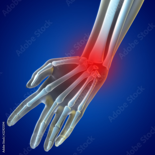 Illustration: Wrist Pain Wrist Pain