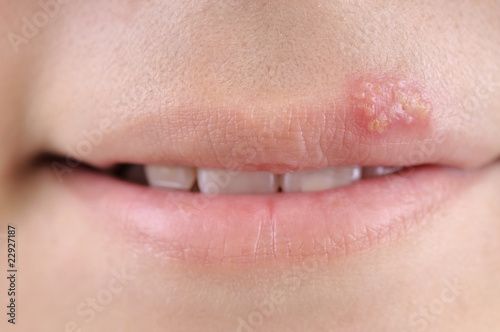 Foto: Close up of lips affected by herpes. Close up of lips affected by herpes.