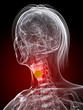 markierter Kehlkopf mit Tumor