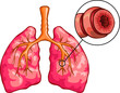 Asthma