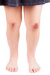 Images : Scraped knees of a little girl