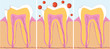 Three phase of caries treatment, vector illustration