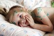 Photo: Girl suffers chickenpox Girl suffers chickenpox