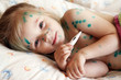 Photo: Girl suffers chickenpox Girl suffers chickenpox