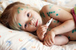Girl suffers chickenpox