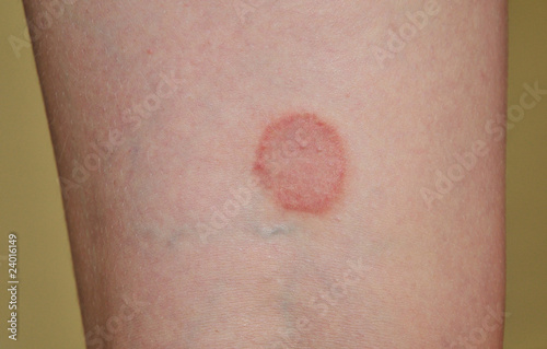 Photo: lichen ruber planus lichen ruber planus
