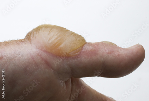 Photo: water blister water blister