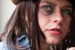 Close up of girls face with bruised eye