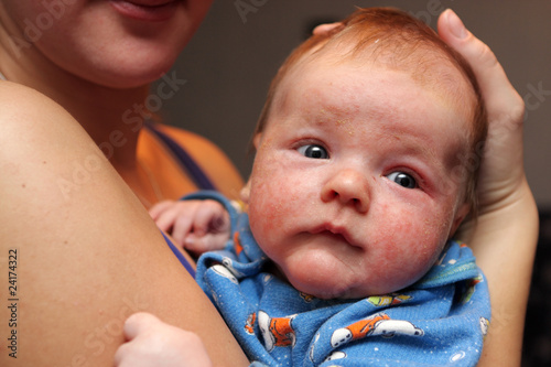 Photo: Baby has eczema on his face Baby has eczema on his face