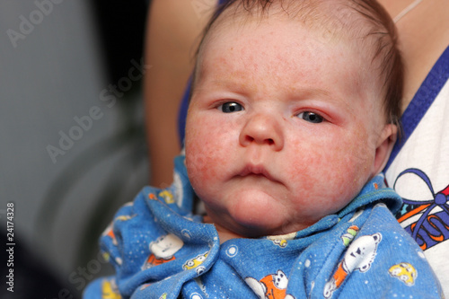 Photo: Baby with allergic diathesis Baby with allergic diathesis