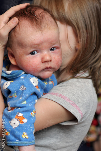 Photo: Baby with eczema on face Baby with eczema on face