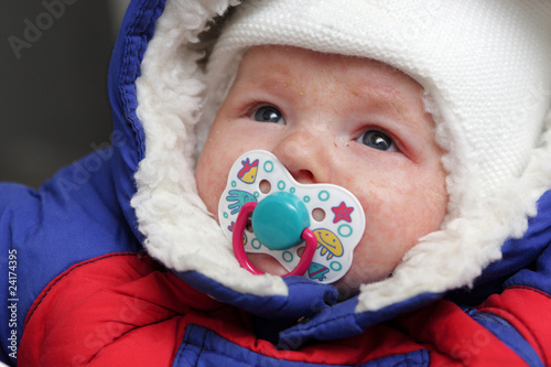 Photo: Infant has eczema on his face Infant has eczema on his face