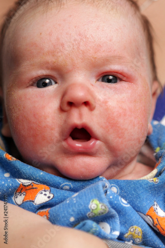Photo: Infant with allergic diathesis Infant with allergic diathesis