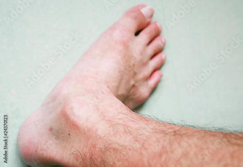 Photo: Skin rash Skin rash