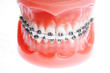 Dentures with braces isolated on white