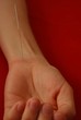 Acupuncture - hand