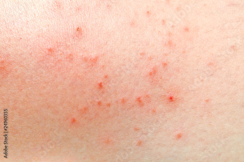 Photo: wounds on woman skin wounds on woman skin