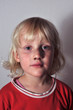 Kind mit blauen Flecken 3