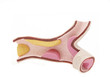 Photo: Cholesterol plaque Cholesterol plaque
