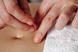 Foto: Acupuncture hands Acupuncture hands