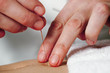 Foto: Working hands of acupuncture Working hands of acupuncture