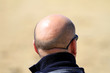 Photo: calvitie calvitie