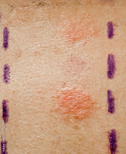 Photo: Skin Allergy Patch Test on Back of Patient Skin Allergy Patch Test on Back of Patient