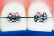 Front teeth braces super macro , shallow depth of field Front teeth braces super macro , shallow depth of field