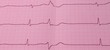 EKG