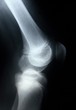X-ray picture showing knee joints