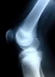 X-ray picture showing knee joints