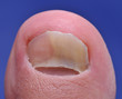 Close up image of foot toe nail suffering from fungus infection